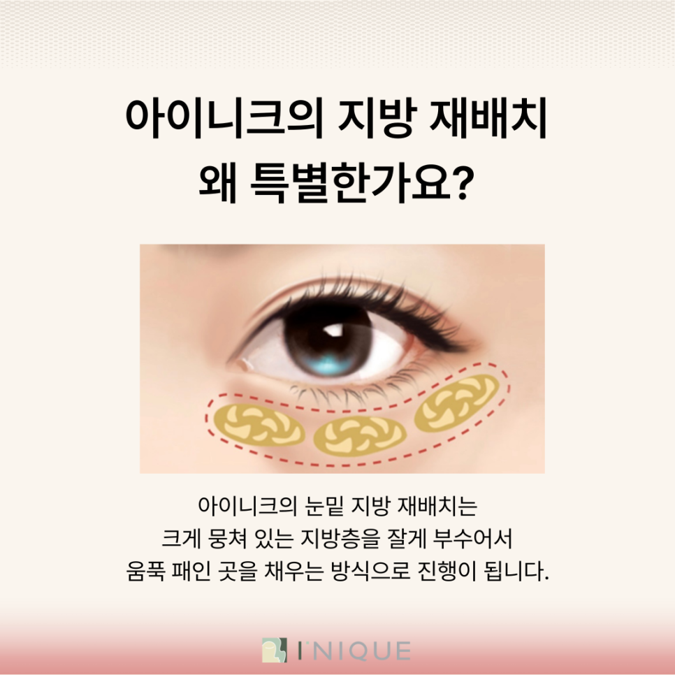 눈밑지방성형 어떤 방식이 좋을까? 관련 이미지 4