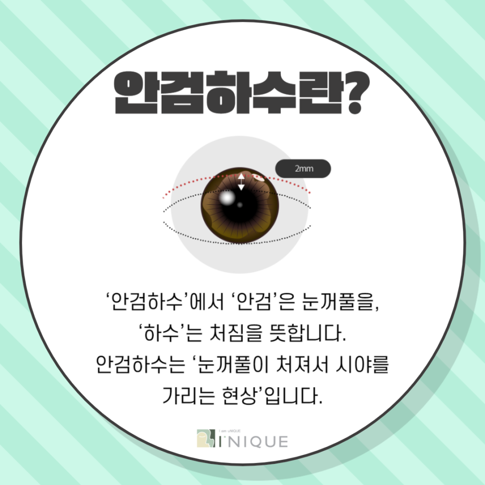 Drooping Eyelid Procedure, with Accurate Diagnosis and Safe Treatment image 3