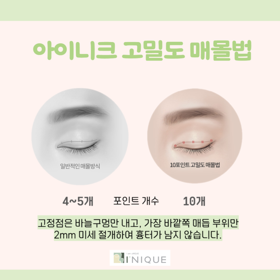 쌍꺼풀만들기 고민하고 계신가요? 관련 이미지 4