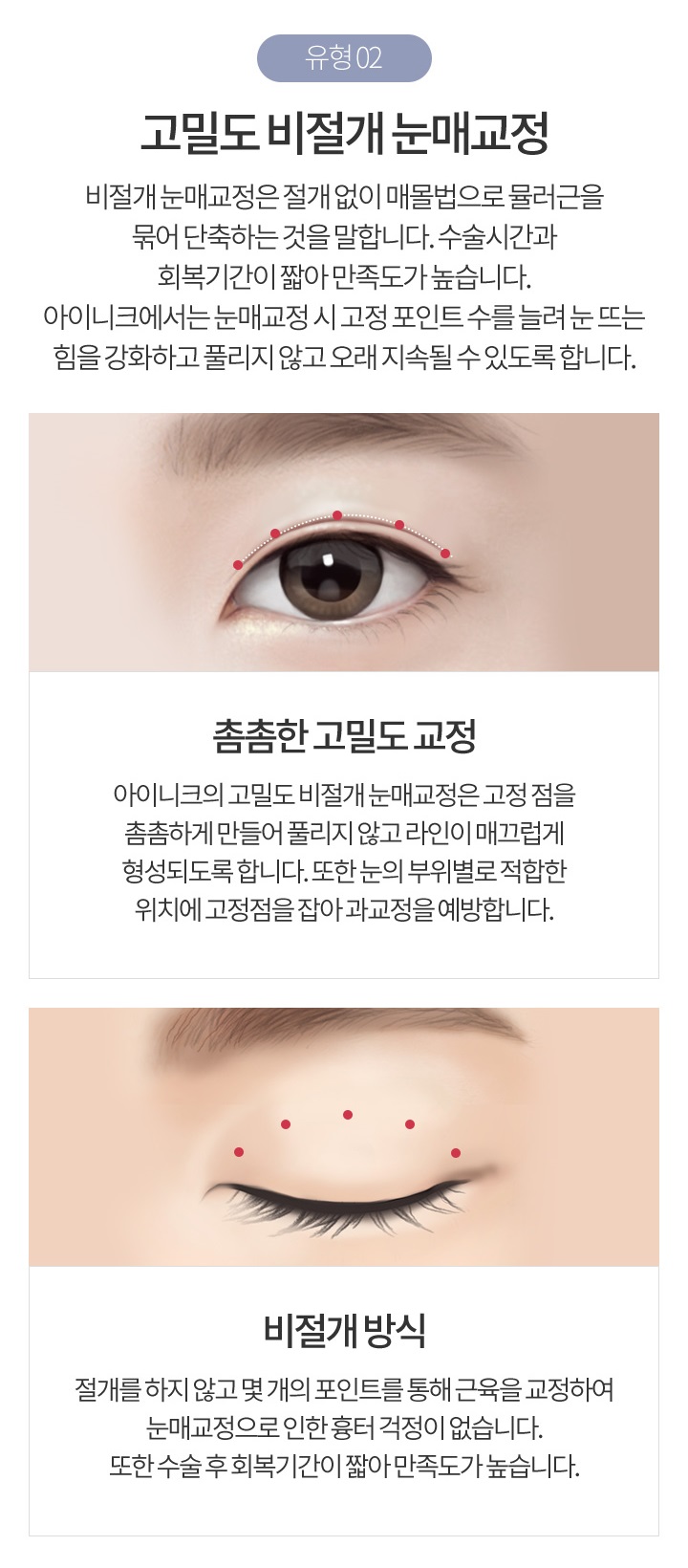 비절개눈매교정부작용 걱정없는 수술은? 관련 이미지 4