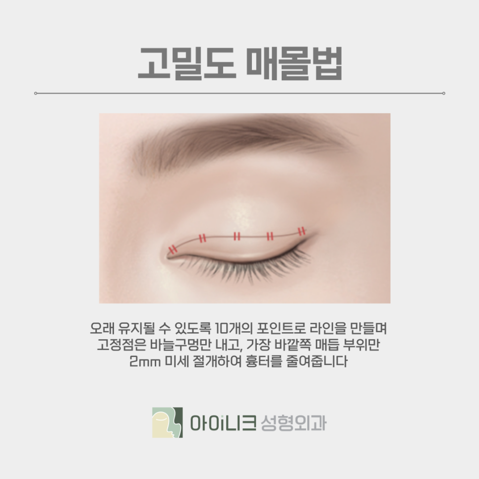 쌍꺼풀종류 본인의 눈 상태에 맞게 선택하기 관련 이미지 11