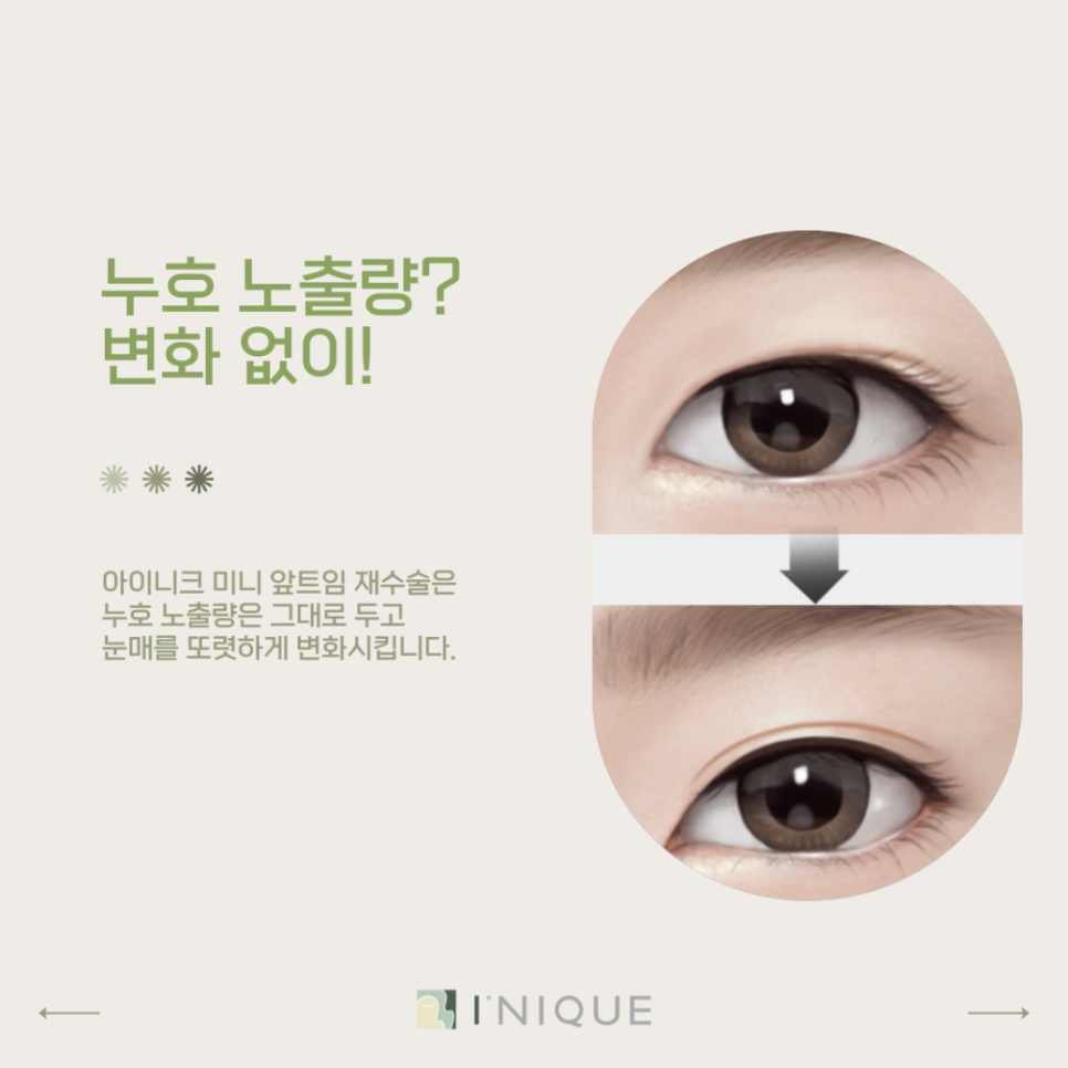 눈재수술잘하는병원, 어떻게 찾을까요? 관련 이미지 6