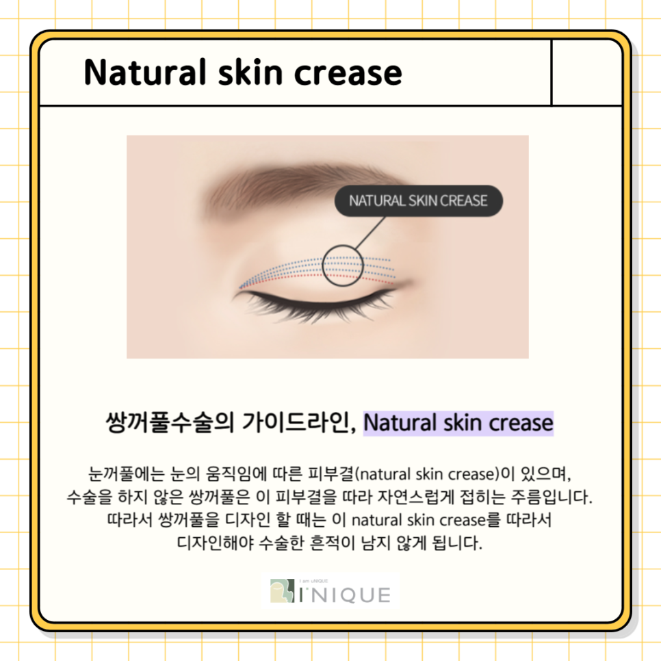 눈성형전후 확실한 변화를 원한다면 관련 이미지 6