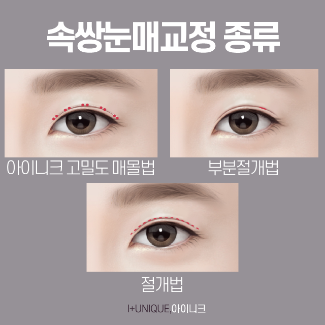 남자눈성형성공 하는 방법? 자연스럽고 부드럽게 관련 이미지 4