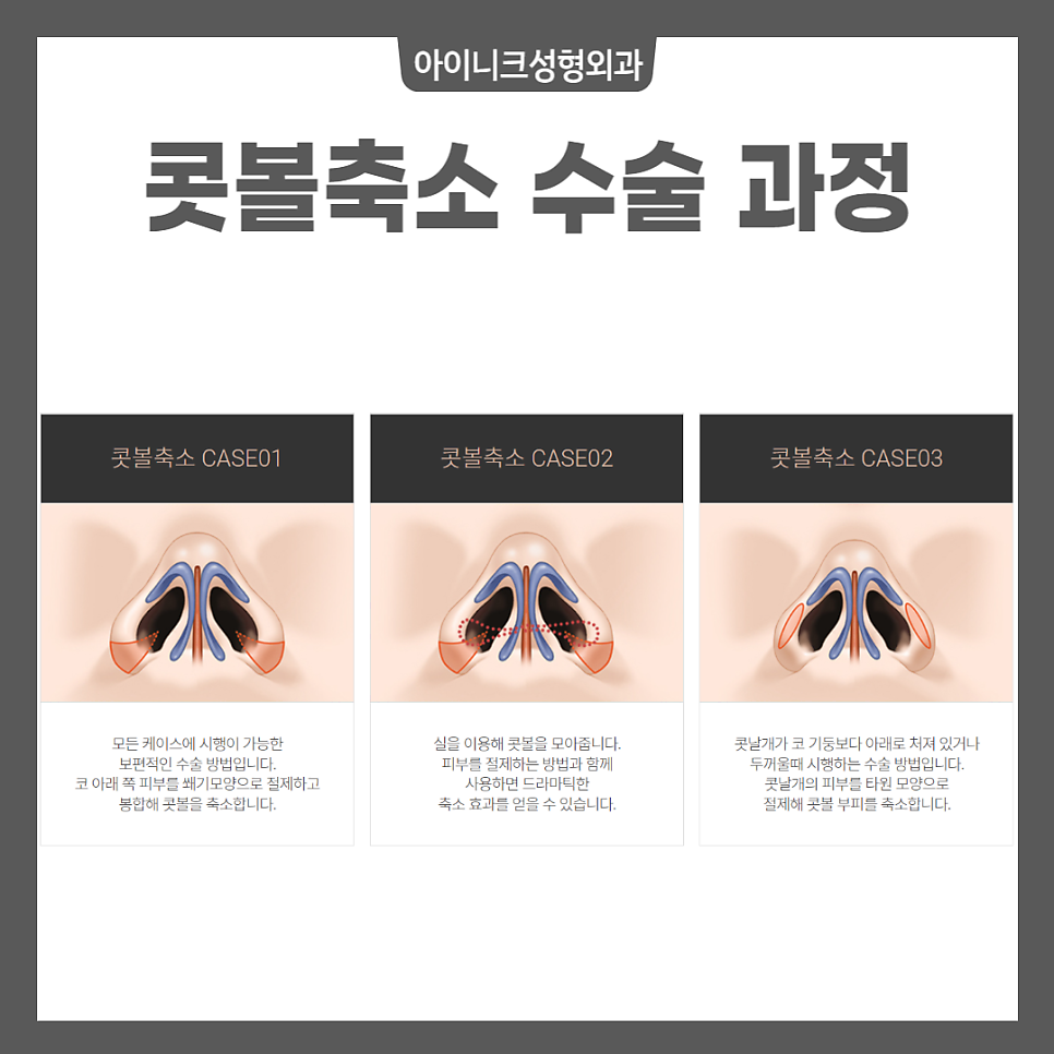 코성형잘하는성형외과의 콧볼 축소 수술 방법 관련 이미지 5