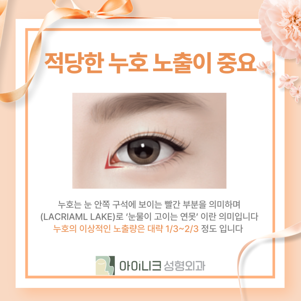 눈재수술잘하는곳 과도한 앞트임 재건이 문제라면 관련 이미지 8