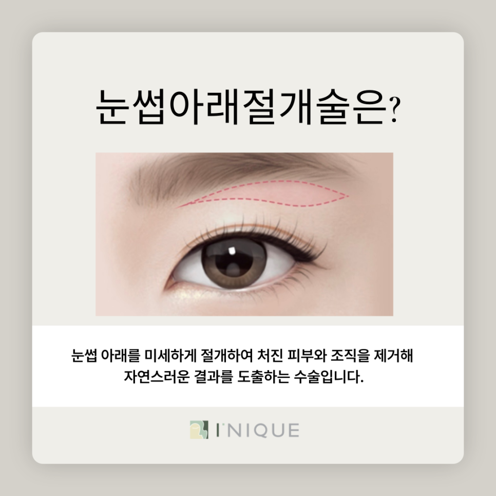 눈썹아래절개로 생기 되찾기 관련 이미지 3