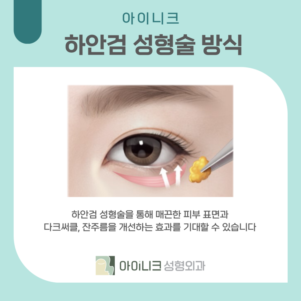 다크써클수술 어둡고 칙칙한 눈밑 개선하기 관련 이미지 14
