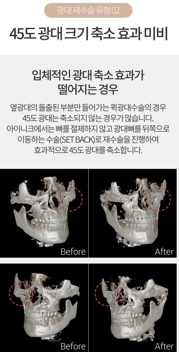 남자안면윤곽수술비용도 아이니크에서 알아보자! 관련 이미지 7