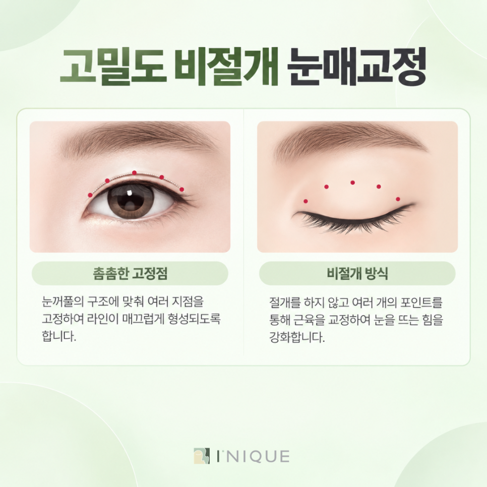 비절개눈매교정, 눈을 뜨는 힘부터 확인해야 하는 이유 관련 이미지 4