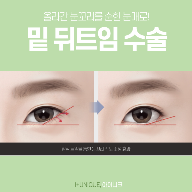 앞, 뒤트임재수술은 아이니크 성형외과에서! 관련 이미지 6