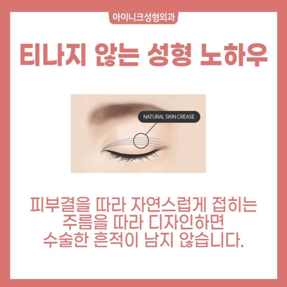 자연스러운 남자무쌍눈매를 원한다면 관련 이미지 4