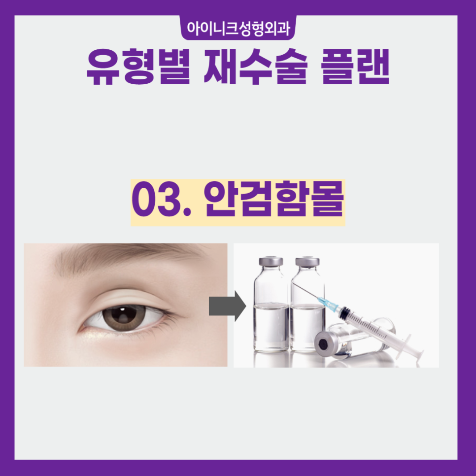실패 없는 압구정눈성형 재수술 플랜 관련 이미지 5