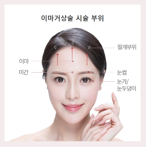 내시경이마거상술 깊은 주름과 처진 눈가를 한 번에! 관련 이미지 2