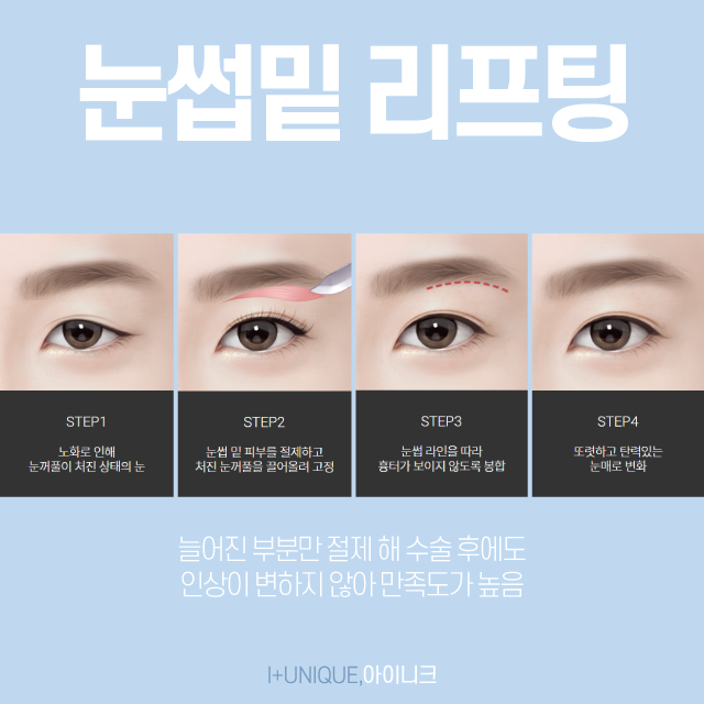 중년 눈 성형, 상안검성형술을 추천하지 않는 이유는? 관련 이미지 3