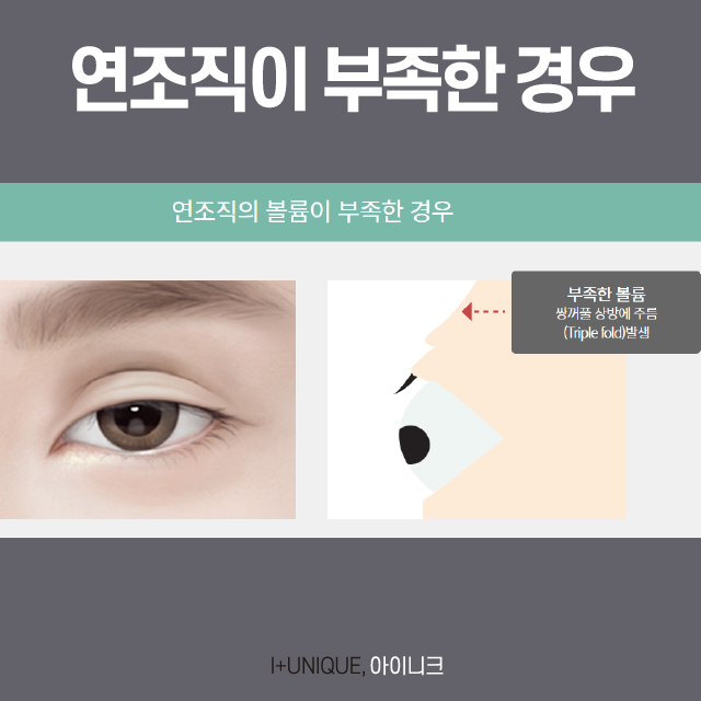 쌍꺼풀 여러겹 해결하고 싶다면? 관련 이미지 4