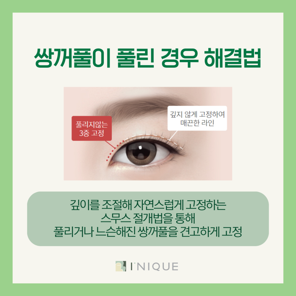 Sinsa Station Eye Revision Surgery: How Can Multiple Eyelid Folds Be Resolved? image 5