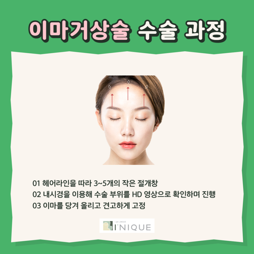 처진눈수술방법으로 또렷한 인상 만들기 관련 이미지 3
