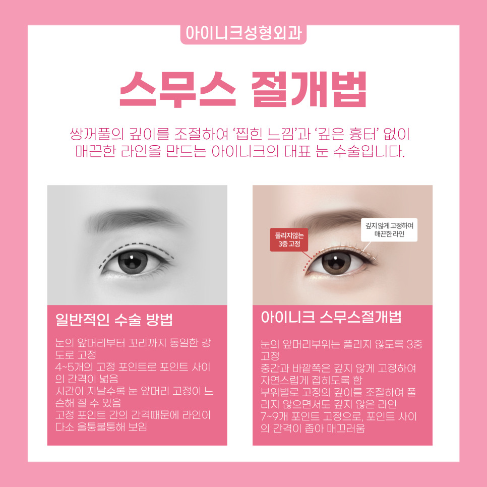 연예인눈성형을 원한다면 눈 성형 전문의에게! 관련 이미지 3