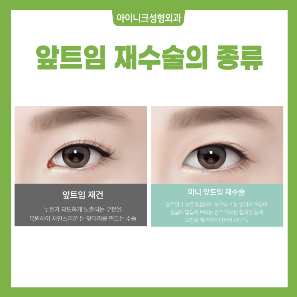 앞트임 재건 수술 경험 많은 병원에서 안전하게, 자연스럽게 관련 이미지 2