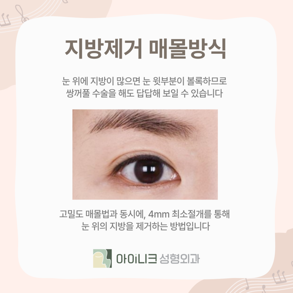 아이들 눈매 원하는 사람~ 연예인 쌍꺼풀의 비밀! 관련 이미지 10