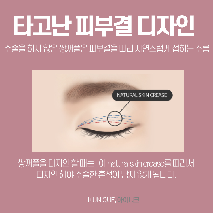 눈수술잘하는곳을 알아보려면 아이니크성형외과와 이것부터 알아보자 관련 이미지 5