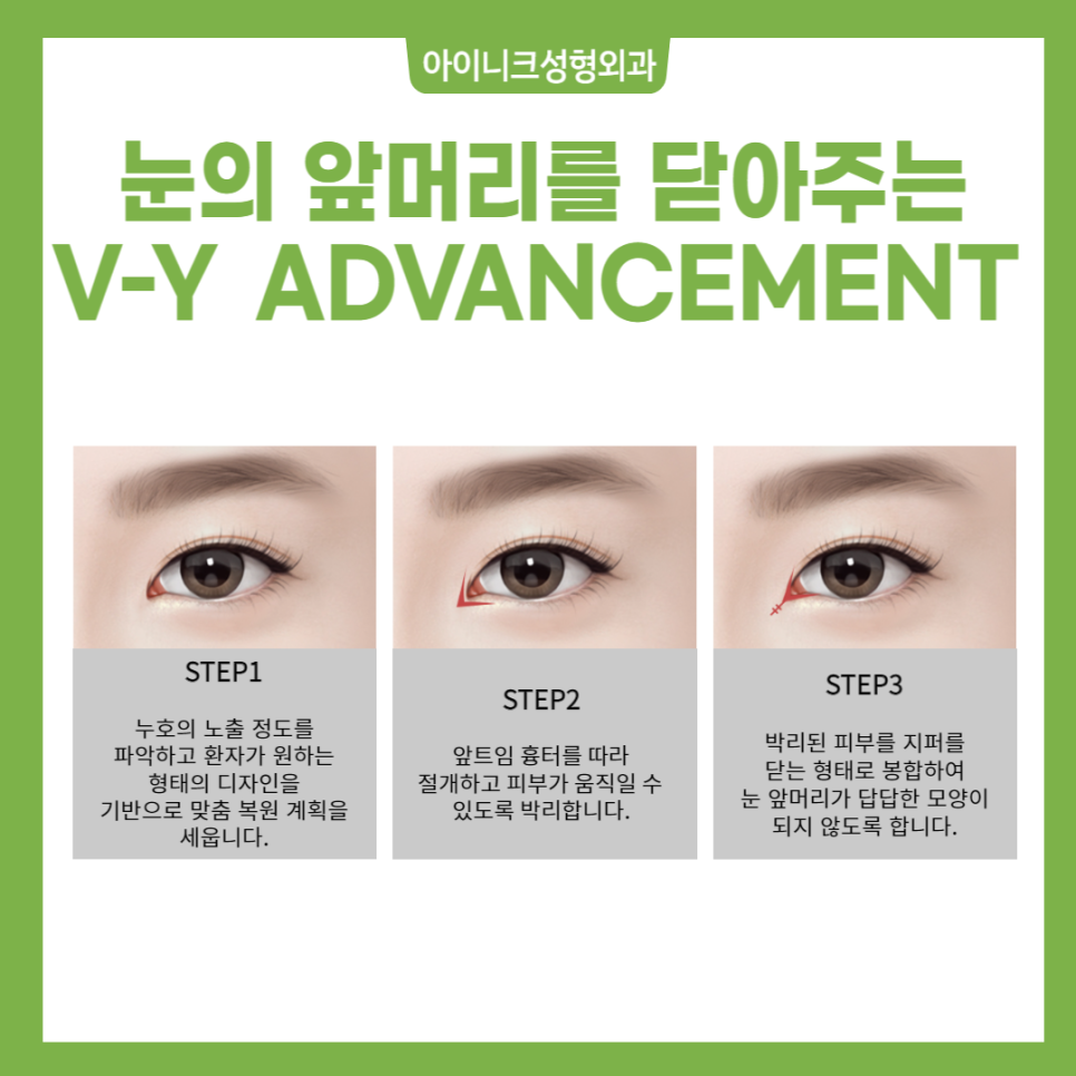 앞트임 재건 수술 경험 많은 병원에서 안전하게, 자연스럽게 관련 이미지 3