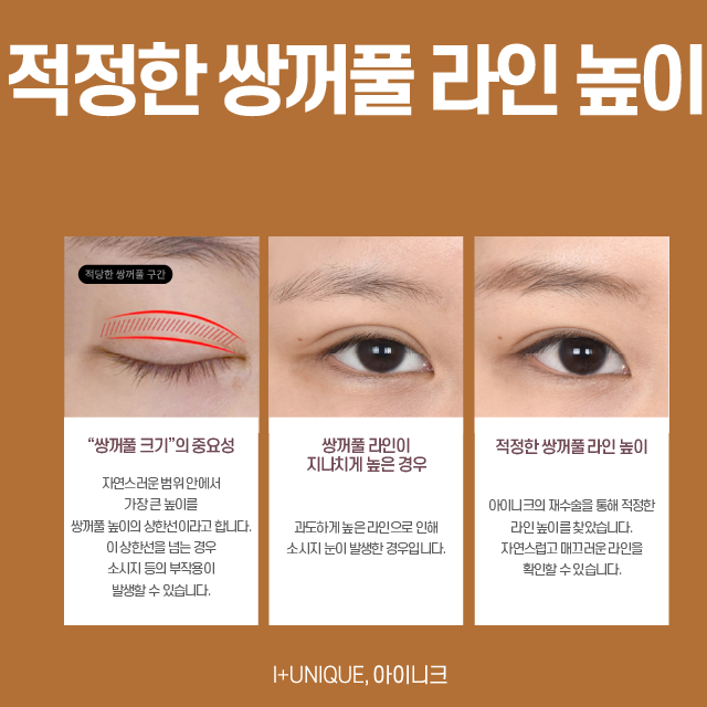 20대눈성형 자연스러움이 최고 관련 이미지 3