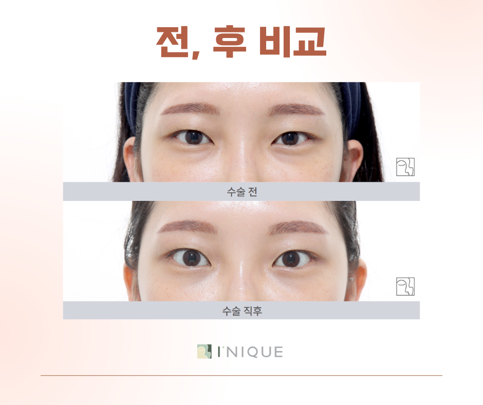 앙코르눈밑지로 환한 인상 만들기 관련 이미지 7