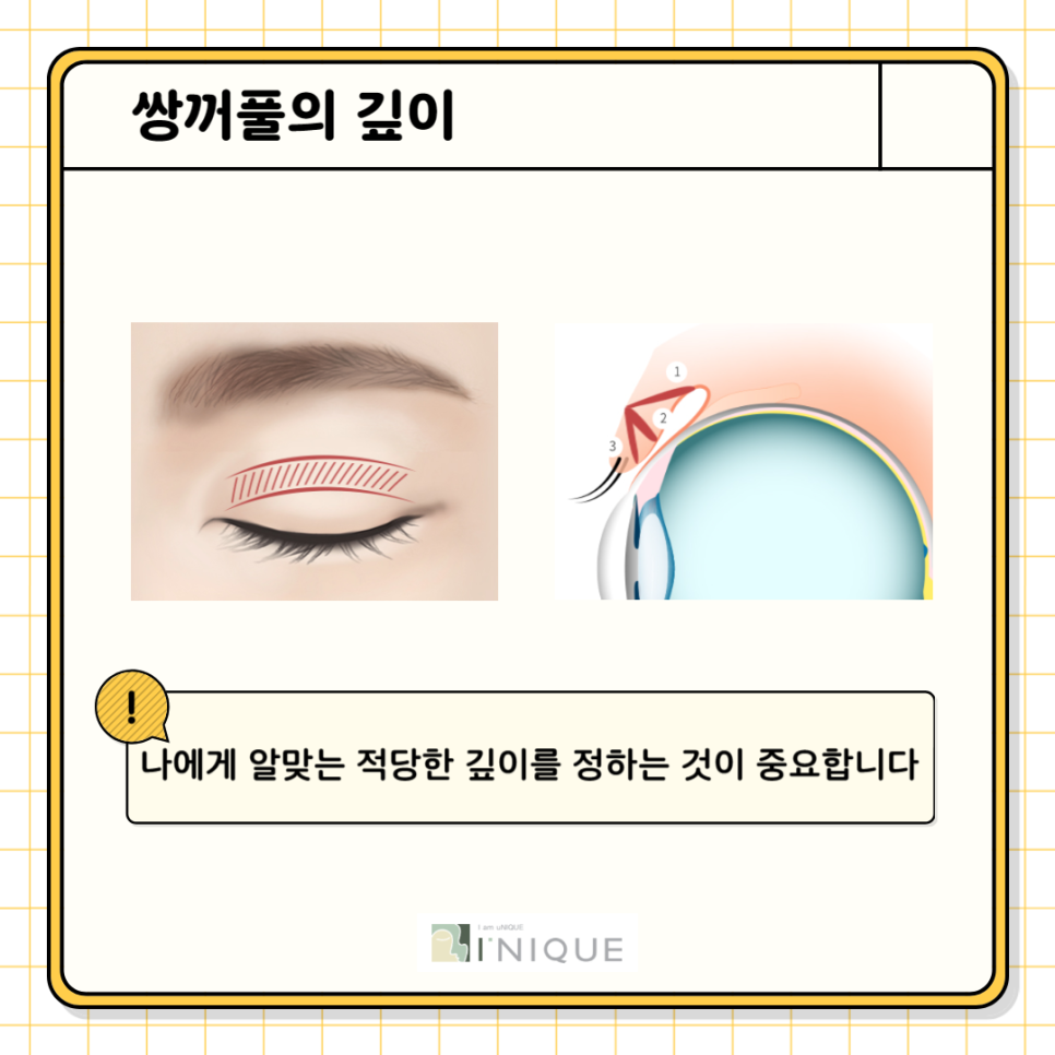 눈성형전후 확실한 변화를 원한다면 관련 이미지 4