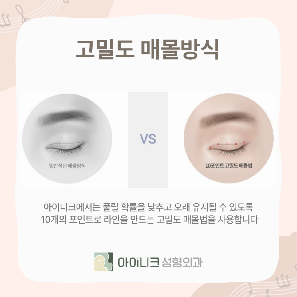 아이들 눈매 원하는 사람~ 연예인 쌍꺼풀의 비밀! 관련 이미지 8