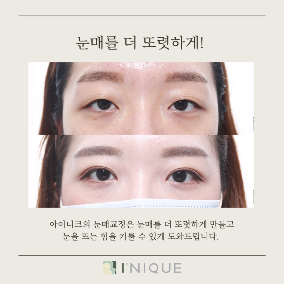 안검하수병원추천, 무엇을 고려해야 할까요? 관련 이미지 5