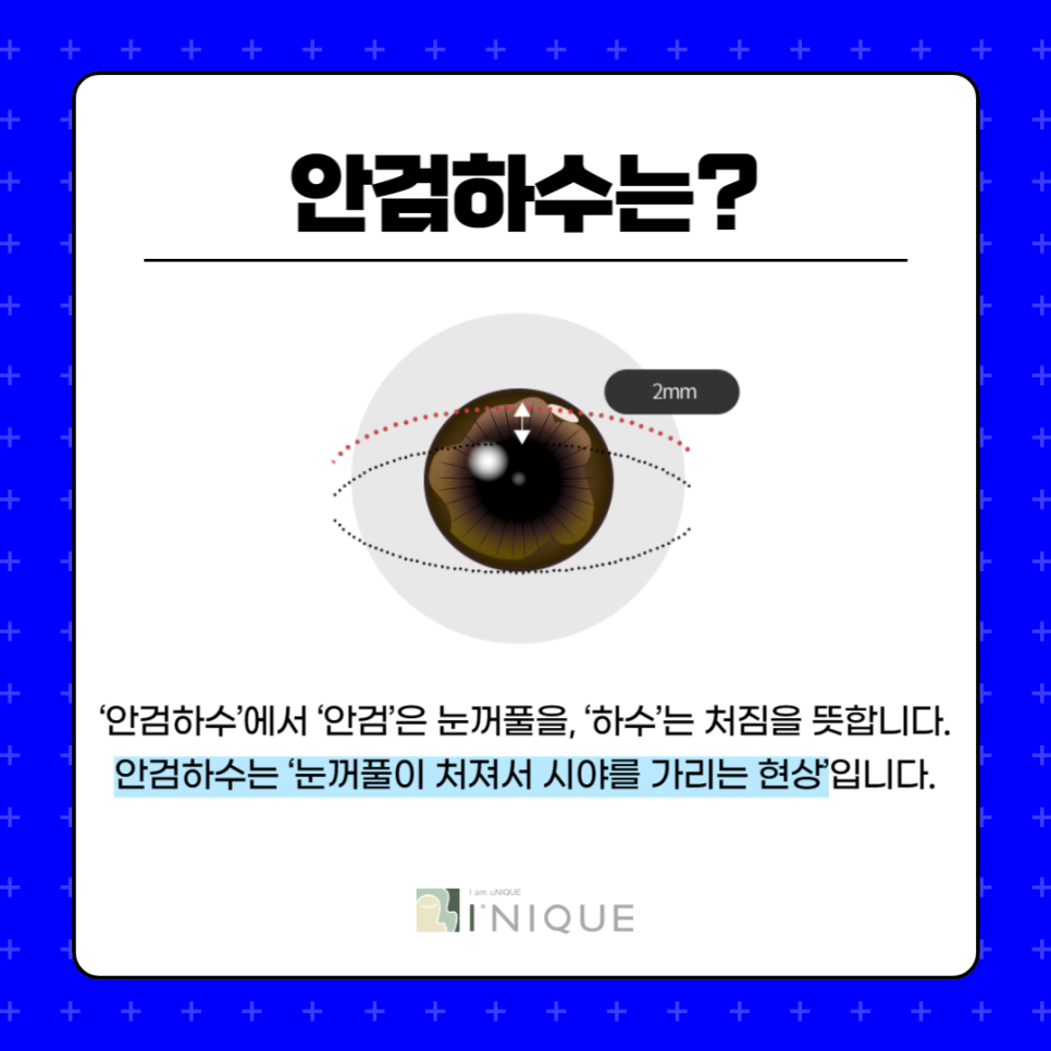 남자무쌍안검하수 자연스러운 교정을 원한다면 관련 이미지 2