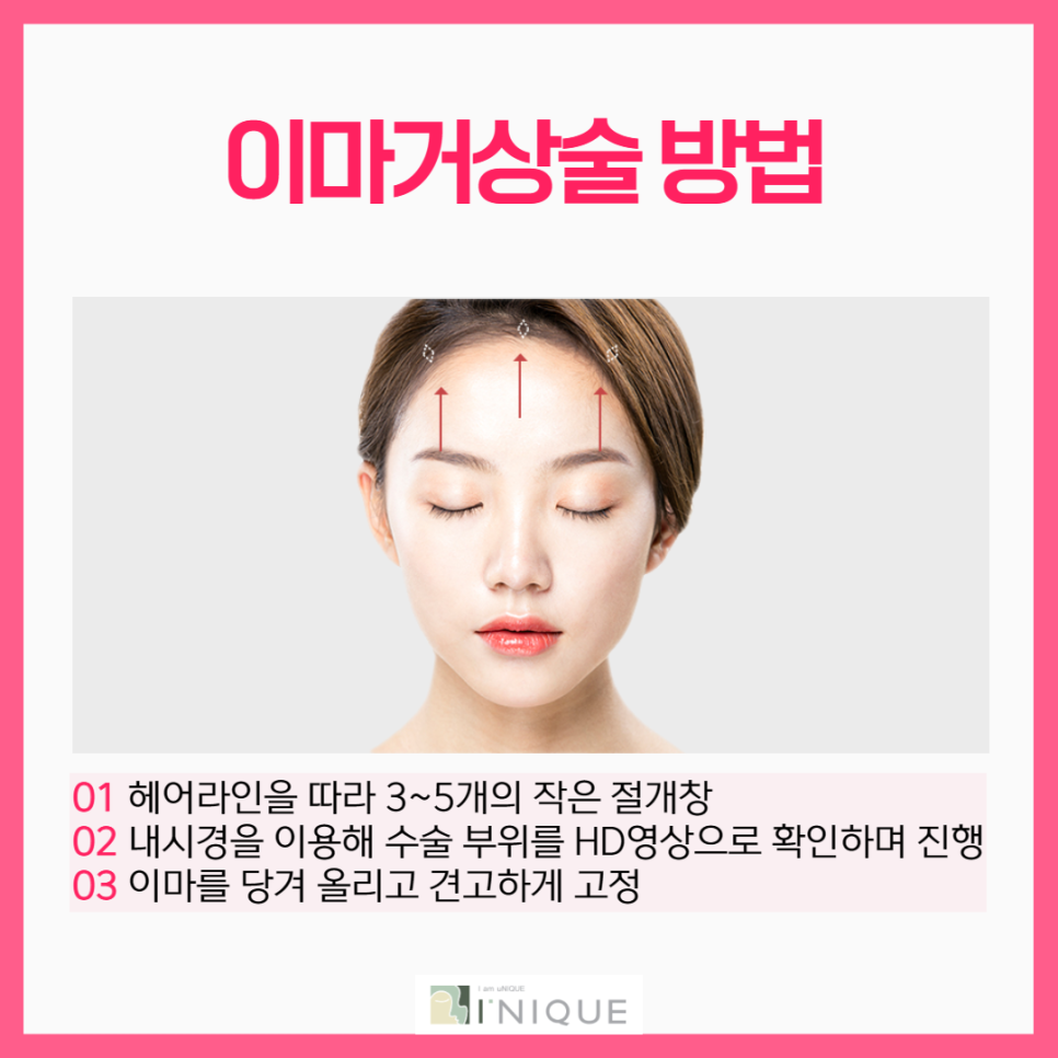 엔도타인이마거상, 흉터는 적게 리프팅은 확실하게! 관련 이미지 4
