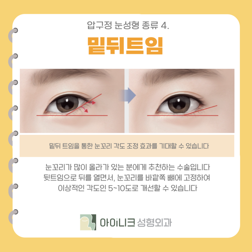 Types of Eye Surgery in Apgujeong: Making the Eye Shape Clearer and Brighter with Canthoplasty image 7