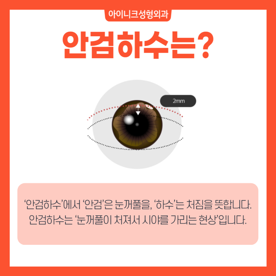Apgujeong Ptosis: Correct It Without Incision! image 2