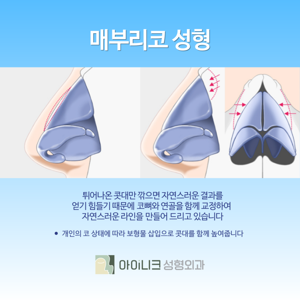 남자코성형잘하는곳 어떻게 진행할까? 관련 이미지 7