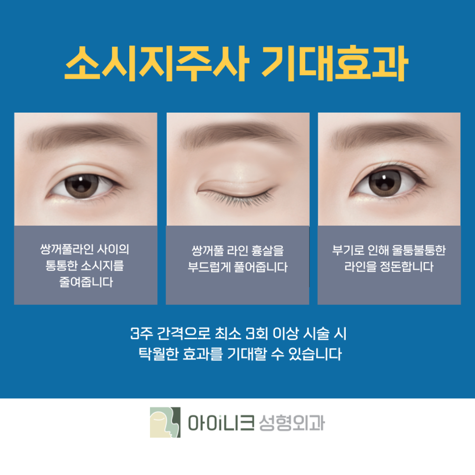 쌍수재수술비용 간편한 소시지 주사로 개선하기 관련 이미지 12