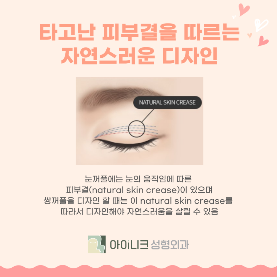 쌍꺼풀잘하는곳 어디로 가야할까? 관련 이미지 5