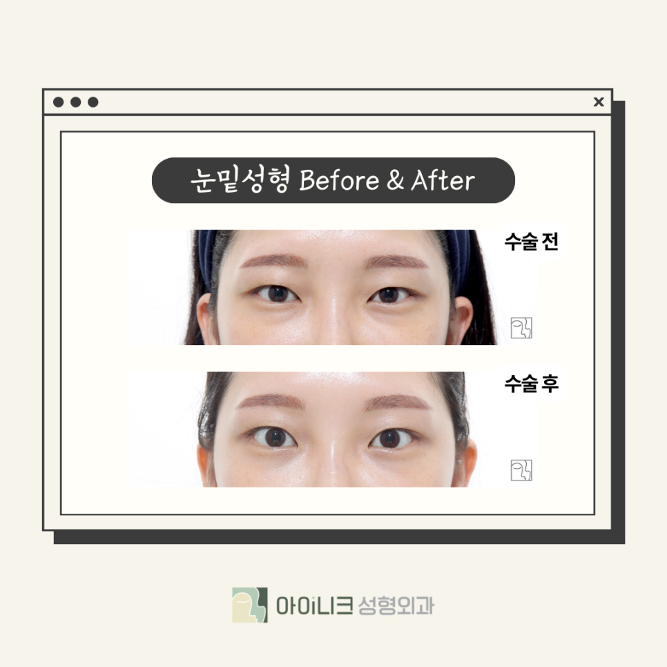 서울눈밑성형, 노하우가 중요 관련 이미지 5