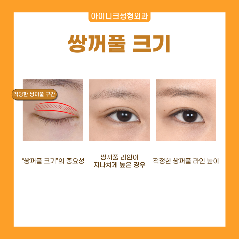 쌍수성형외과 자연스러움을 원한다면 눈성형전문 아이니크로 관련 이미지 3