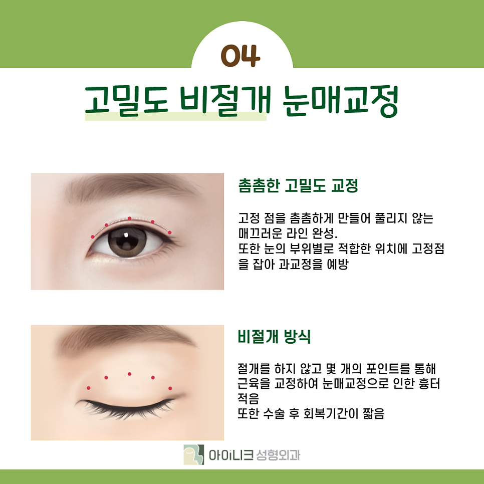 눈매교정 쌍수 차이는 무엇일까요? 관련 이미지 5