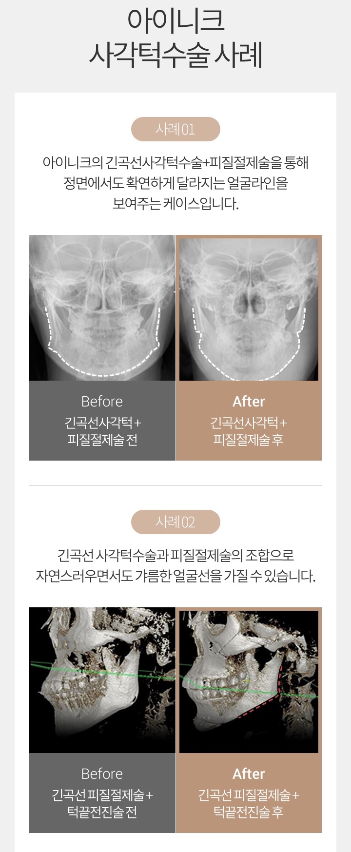 피질절제술로 정면에서도 V라인 관련 이미지 6