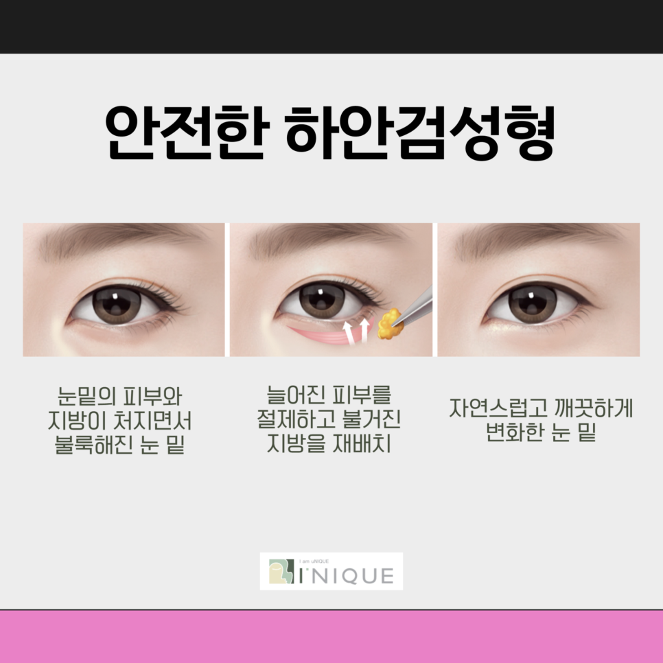 Are You Worried About Sagging Eyelids in Middle Age? image 4