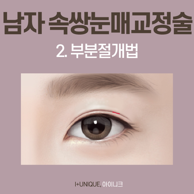 쌍꺼풀 없이도 또렷한 눈매를 원한다면 무쌍눈매교정술! 관련 이미지 3