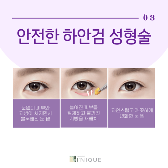 Restoring a Lively Eye Appearance with Drooping Eye Surgery image 4