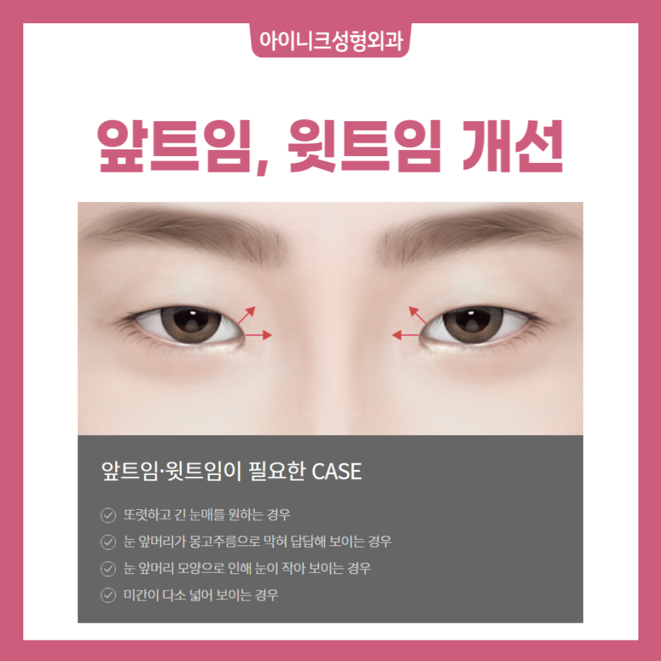 Blepharoplasty for Large, Beautiful Eyes image 5