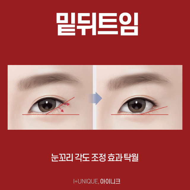 또렷하고 긴 눈매를 원하는 남자분들, 밑트임보다 밑뒤트임을 추천드립니다! 관련 이미지 5