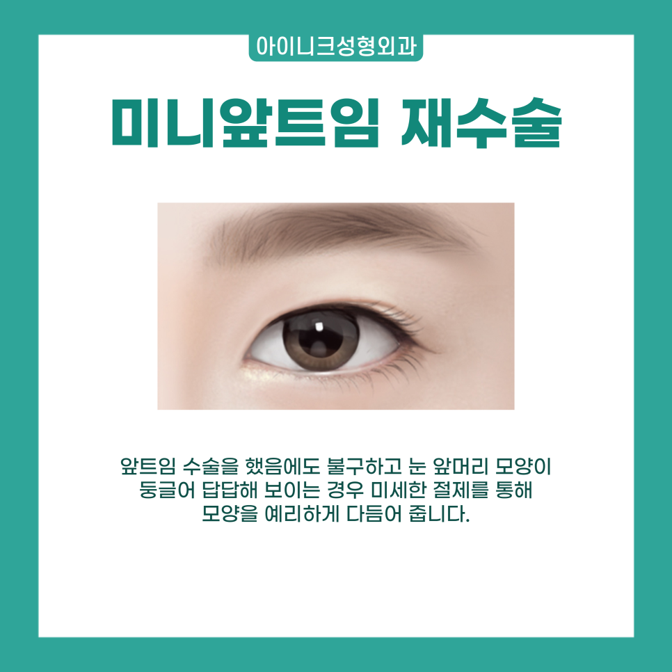 앞트임전후 확실한 인상의 변화를 원한다면 관련 이미지 4