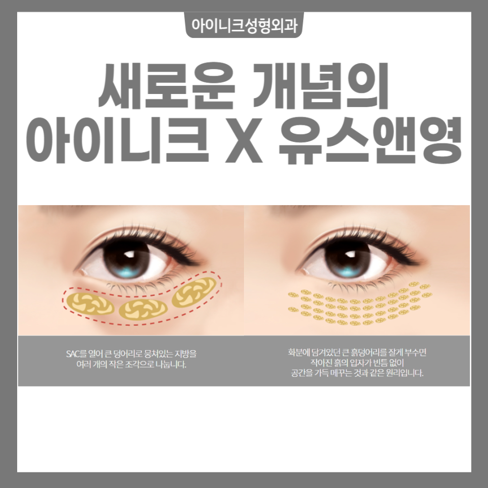 눈밑성형 더욱 젊고 자신있게 유스앤영 X 아이니크 관련 이미지 2
